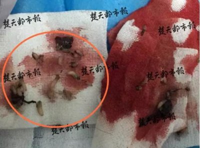 ​08.10 - 周到晨报：恐怖！男子后脑勺上长出50条蛆虫！竟是因为他的一个平常动