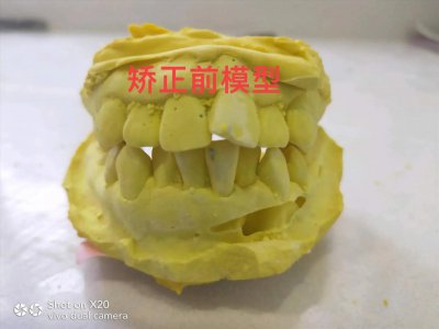 ​牙齿矫正大概要花费多少钱 牙齿矫正花费了多少钱呢？矫正前后
