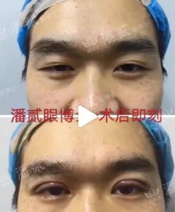​韩式无痕双眼皮 韩式微创三点双眼皮这么好，为什么竟然有医生不愿意做？