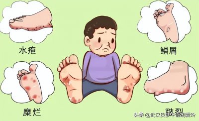 ​脚上起水泡很痒怎么办（脚上起水泡是什么原因，很痒，用什么药膏）