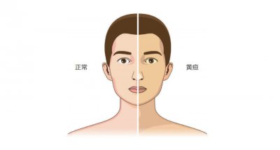 ​黄疸是什么意思（黄疸是怎么回事？不只是皮肤有点“黄”）