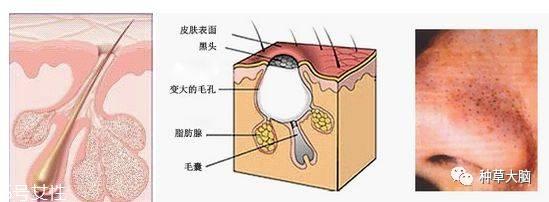 小气泡是什么 小气泡去黑头有效吗