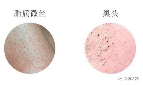 小气泡是什么 小气泡去黑头有效吗