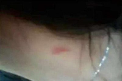 ​吻痕用鸡蛋热敷管用吗 吻痕用鸡蛋敷过后什么时候能消