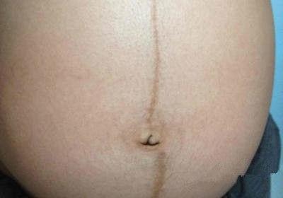 妊娠线真的能看男孩女孩吗？孕期你的妊娠线是什么样子的？