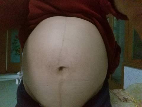 妊娠线真的能看男孩女孩吗？孕期你的妊娠线是什么样子的？