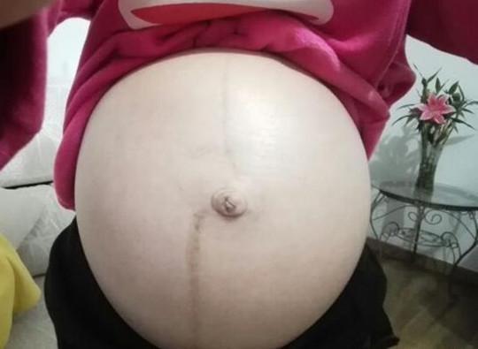 妊娠线真的能看男孩女孩吗？孕期你的妊娠线是什么样子的？