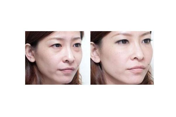 眼袋有细纹了怎么消除 眼袋上有细纹怎么解决