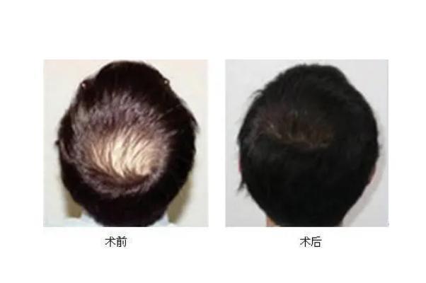植发会自己生长吗 植发会失败吗