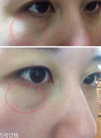 quanis眼膜用法 quanis眼膜怎么贴