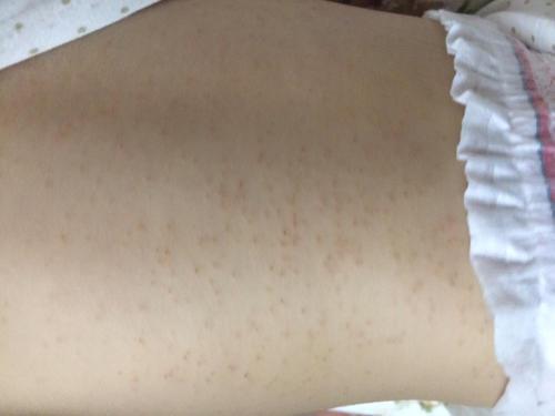 湿疹饮食要注意什么 湿疹不能吃什么