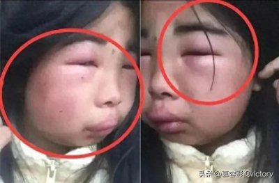 ​亲身经历的痛12岁女生遭校园霸凌3小时，被8人轮扇耳光致耳膜穿孔