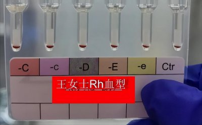 ​黄金血型是什么？有何特别之处？