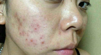 ​女子花6000元祛斑遭“毁容”？医生怒了：提醒多次没人听