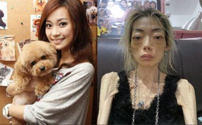 伍智恒: 嫁入豪门8年色衰被抛弃,牙齿掉光胃被切除,体重只剩44斤