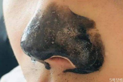 ​草莓鼻是怎么造成的 为什么会有草莓鼻