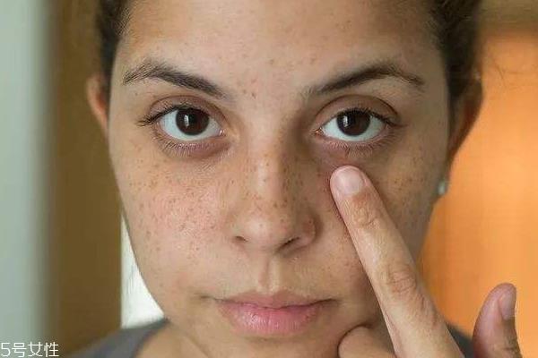 晒后多久会变黑 3天后皮肤就会变黑