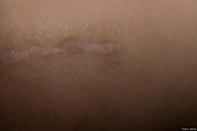 ​二期伤口愈合的介绍及敷料